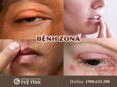 benh-zona-0