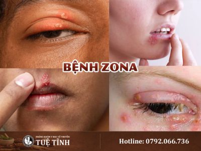 benh-zona-0