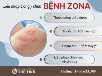 dieu-tri-zona-0
