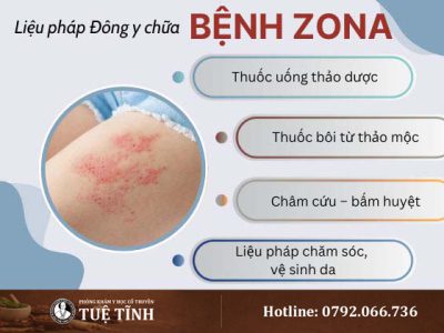 dieu-tri-zona-0
