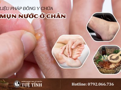 mun-nuoc-o-chan-dieu-tri