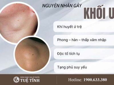 nguyen-nhan-khoi-u